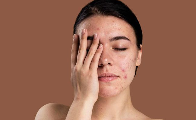 Da nhạy cảm là gì? Đặc điểm của làn da nhạy cảm