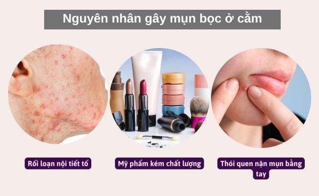Nguyên nhân gây ra mụn bọc ở cằm