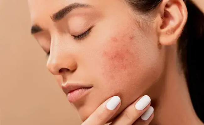 nguyên nhân dùng niacinamide bị lên mụn