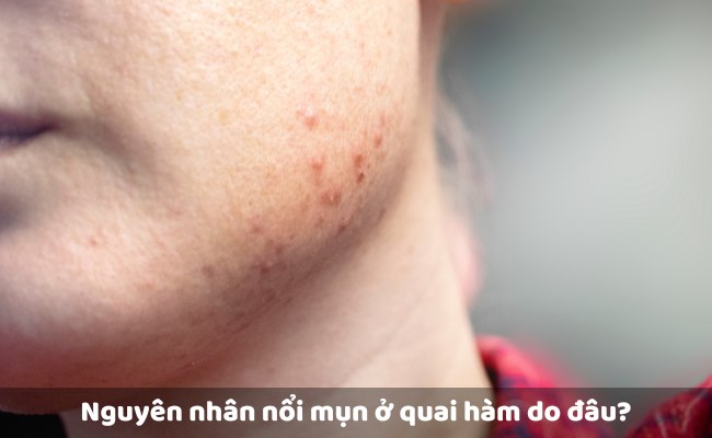 Nguyên nhân nổi mụn ở quai hàm do đâu?