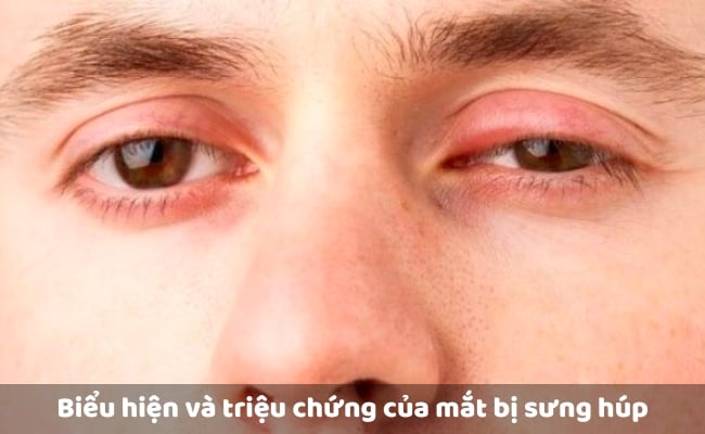 Biểu hiện và triệu chứng của mắt bị sưng húp