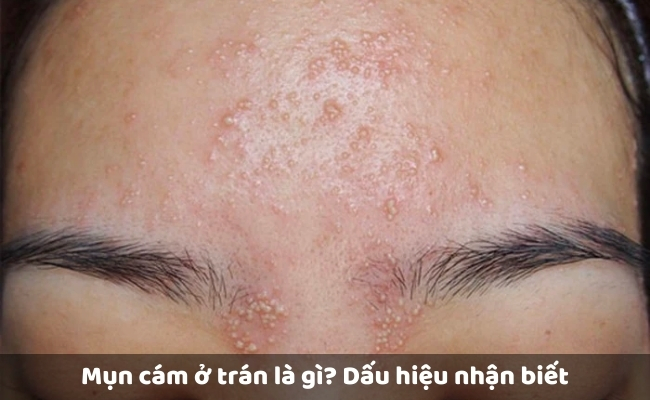 Mụn cám ở trán là gì? Dấu hiệu nhận biết mụn cám ở trán