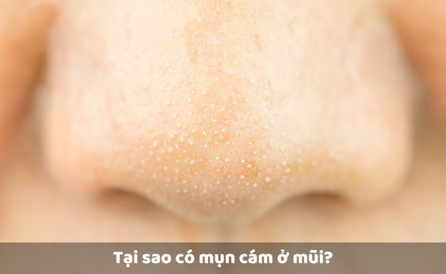 Tại sao có mụn cám ở mũi? Nguyên nhân gây mụn