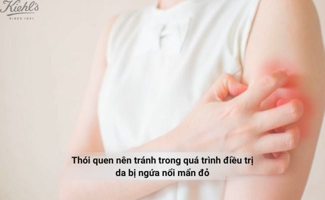 Thói quen nên tránh trong quá trình điều trị da bị ngứa nổi mẩn đỏ