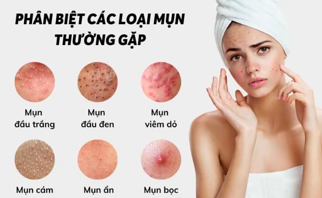 Phân biệt các loại mụn thường gặp trên mặt