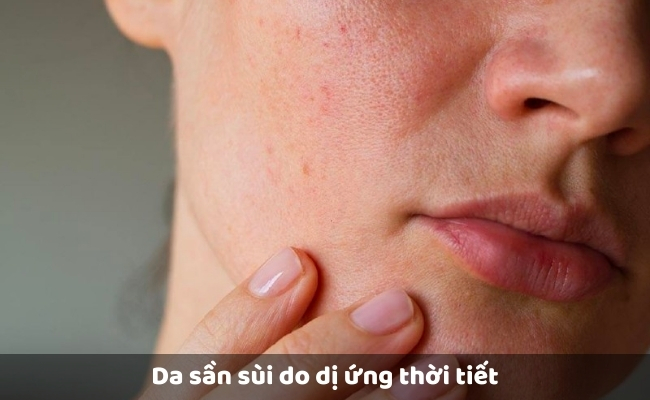 Da sần sùi do dị ứng thời tiết