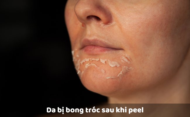 Da bị bong tróc - hiện tượng sau khi peel da thường gặp

