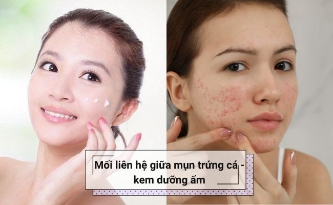 Mối liên hệ giữa mụn trứng cá - kem dưỡng ẩm