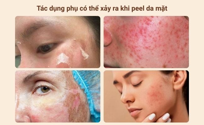Tác dụng phụ có thể xảy ra khi peel da mặt