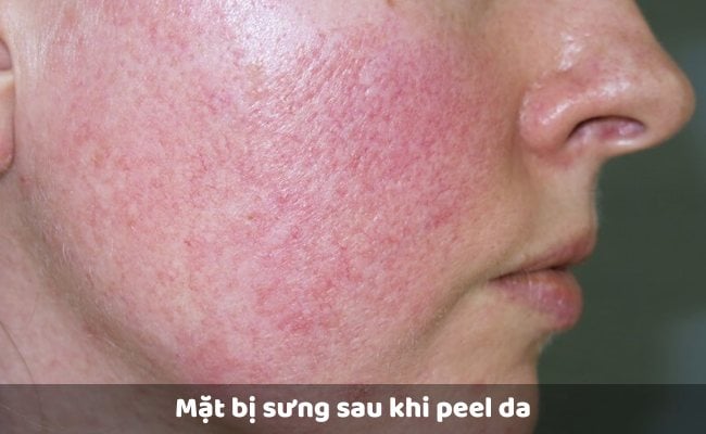 Mặt bị sưng sau khi peel da

