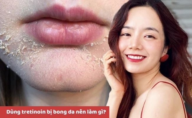 Một số câu hỏi liên quan đến Tretinoin