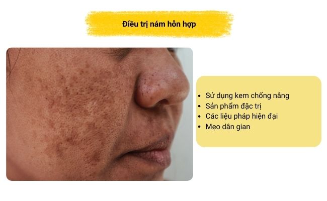 Các cách điều trị nám hỗn hợp hiệu quả và an toàn mà bạn có thể tham khảo