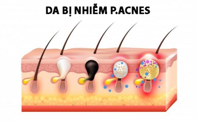 Do vi khuẩn P.Acnes hình thành mụn nhỏ li ti