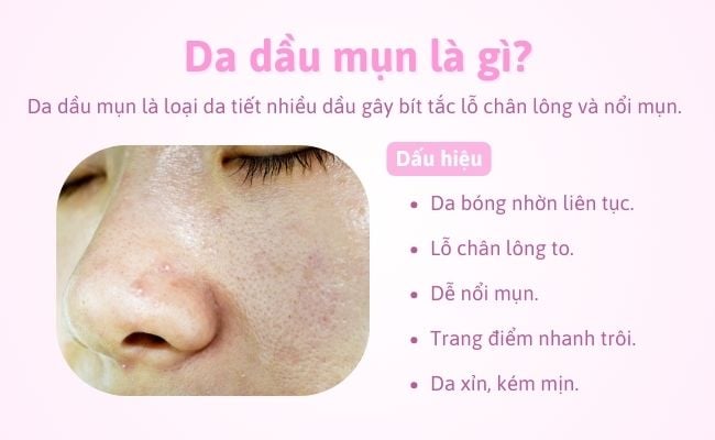 Da dầu mụn là gì? Những đặc điểm nhận biết phổ biến