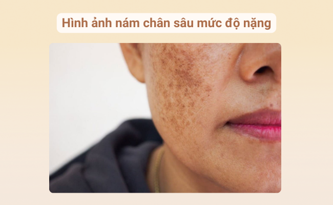 Tổng hợp các hình ảnh thực tế về nám chân sâu ở nhiều mức độ khác nhau trên khuôn mặt.