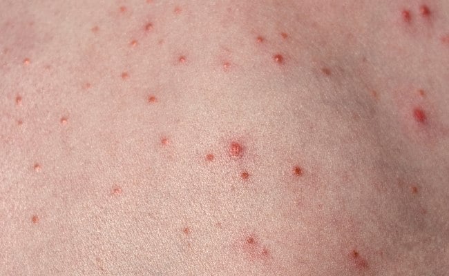 Nổi đốm đỏ, mụn đỏ trên da là gì? Triệu chứng như thế nào?