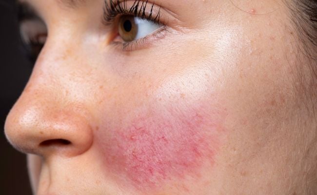 Tái tạo da có nguy hiểm không? Vấn đề có thể gặp phải sau khi tái tạo da