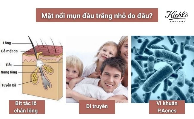 Mặt nổi mụn đầu trắng nhỏ do đâu?