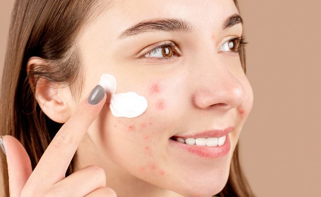 Điều trị các loại mụn trên mặt bằng thuốc, sản phẩm bôi