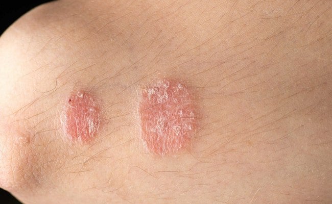 Biểu hiện bệnh vảy phấn hồng

