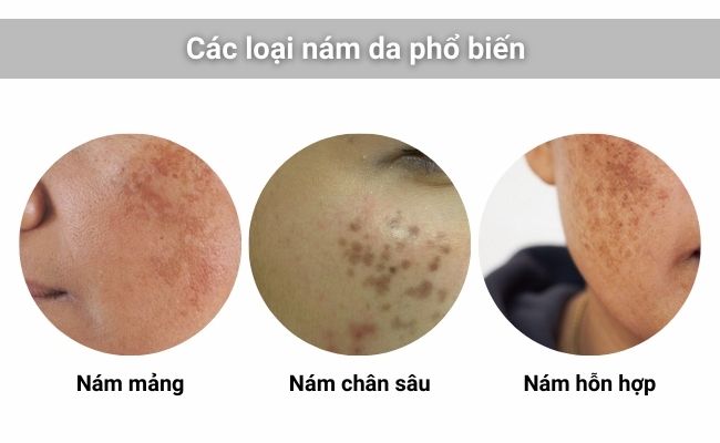 3 loại nám da phổ biến thường gặp ở phụ nữa sau 30 tuổi