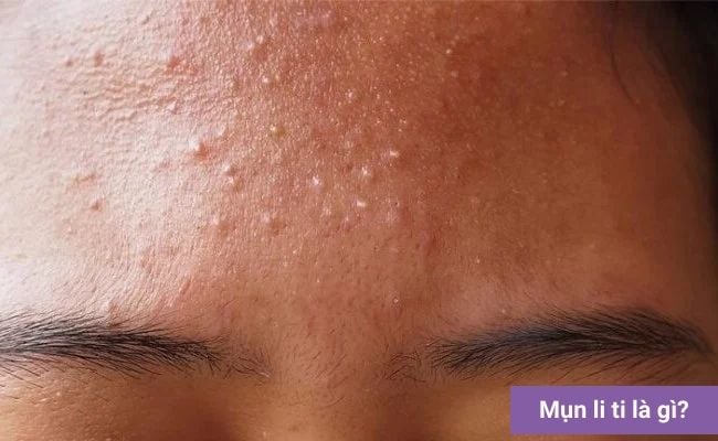 Mụn li ti là gì?