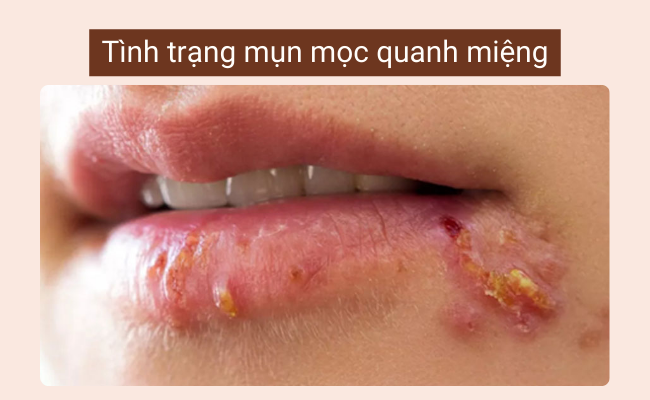 Bị mụn mọc quanh miệng