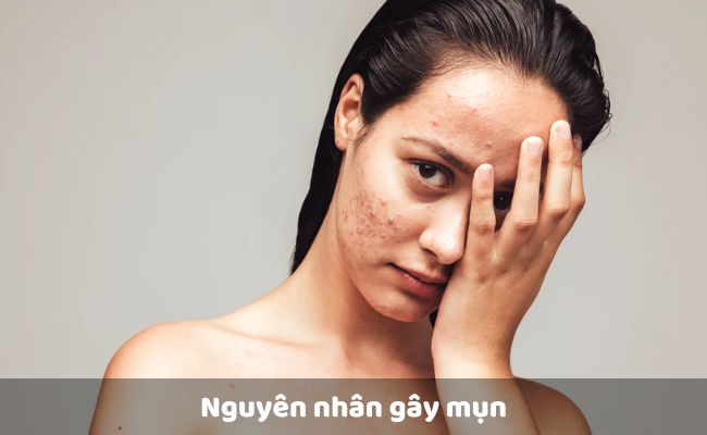 Nguyên nhân gây mụn

