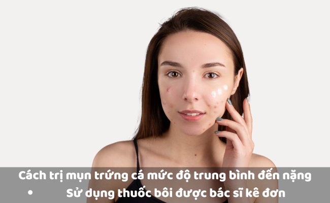 Cách trị mụn trứng cá mức độ trung bình đến nặng

