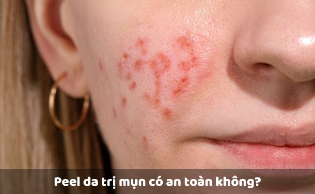 Peel da trị mụn có an toàn không?