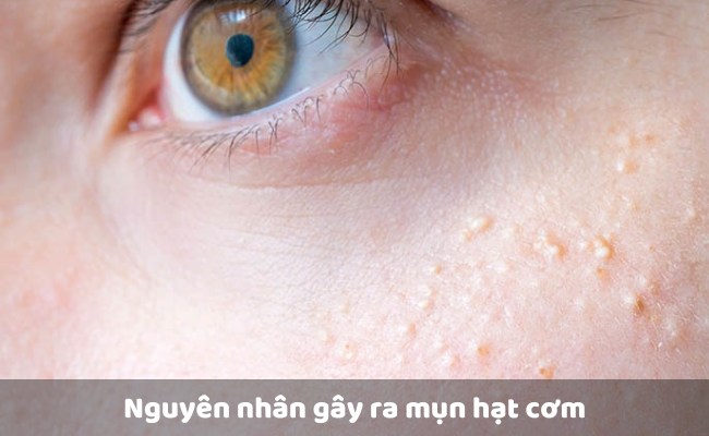 Nguyên nhân gây ra mụn hạt cơm