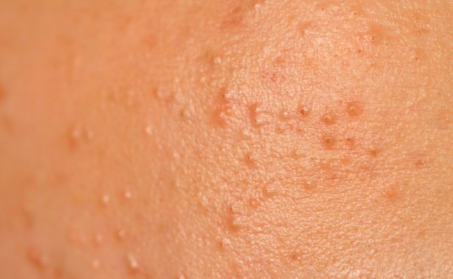 Sự tăng sừng trên bề mặt da gây mụn trứng cá