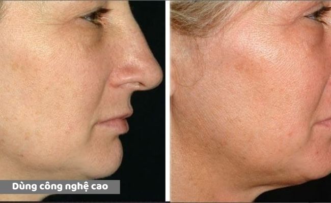 Cách điều trị nếp nhăn trên mặt hiệu quả