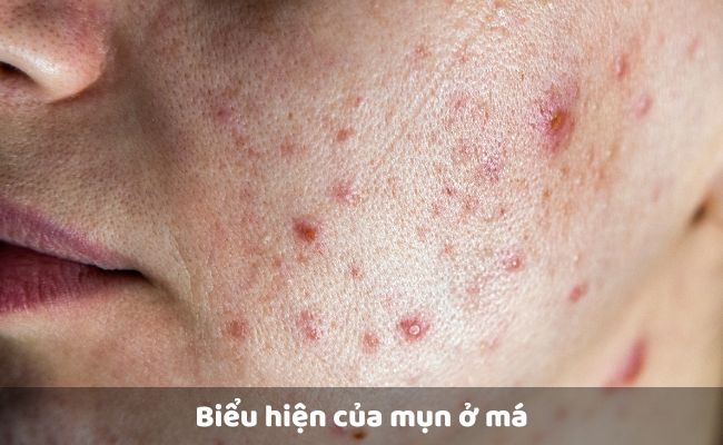 Biểu hiện của mụn ở má