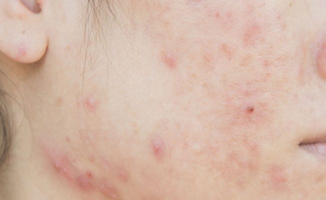 Mụn trứng cá đỏ tuổi dậy thì