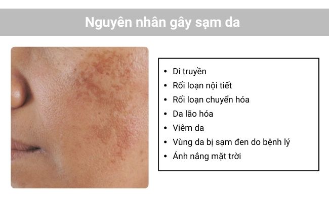 Những nguyên nhân gây sạm da