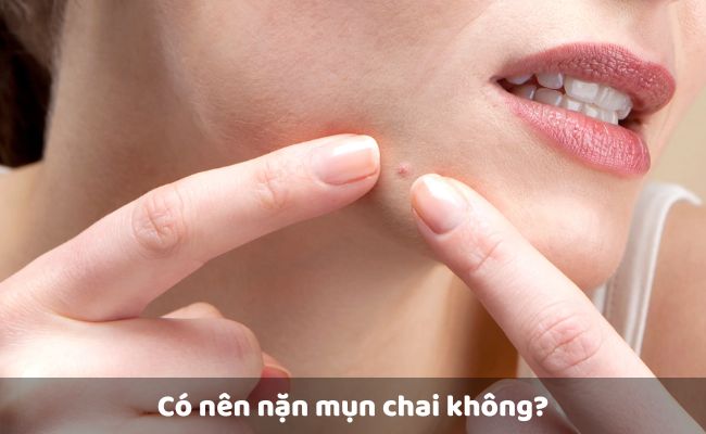 Có nên nặn mụn chai không?
