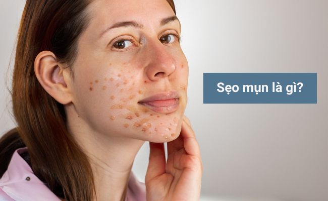 Sẹo mụn là gì?