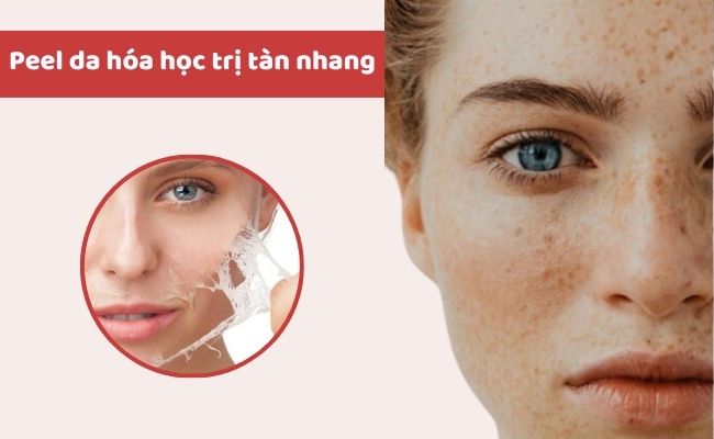 Cách trị tàn nhang tận gốc, an toàn, hiệu quả