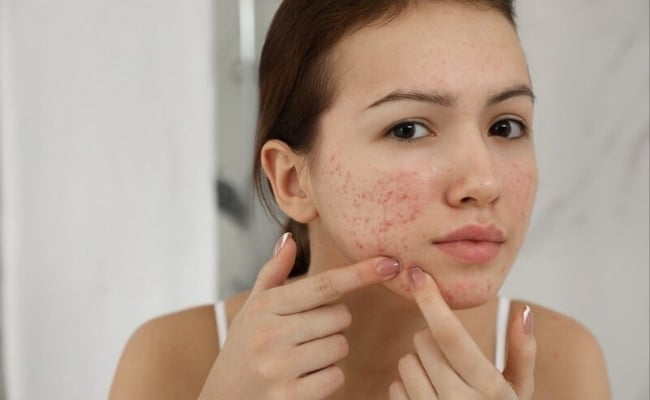 Tác dụng phụ của Glycerin