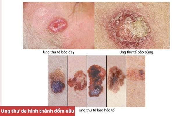 Nguyên nhân nổi đốm nâu