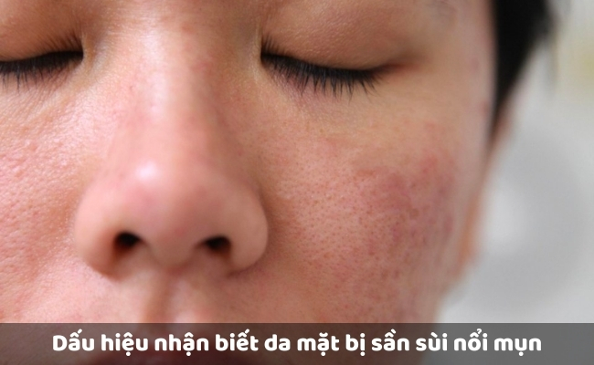 Dấu hiệu nhận biết da mặt bị sần sùi nổi mụn