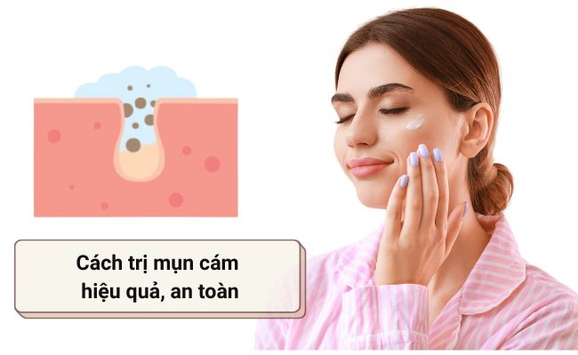 Cách trị mụn cám tại nhà bằng sản phẩm bôi không kê đơn