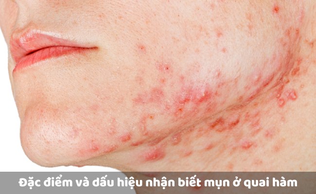 Đặc điểm và dấu hiệu nhận biết mụn ở quai hàm