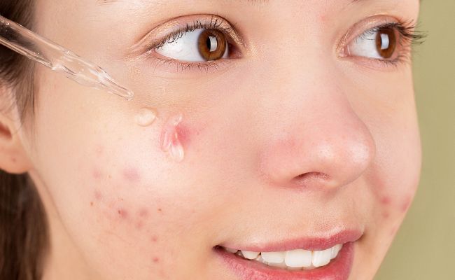 Tiêu chí chọn thuốc chấm mụn an toàn, hiệu quả cao