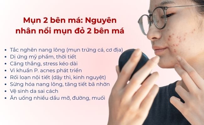 Mụn 2 bên má: Nguyên nhân nổi mụn đỏ 2 bên má