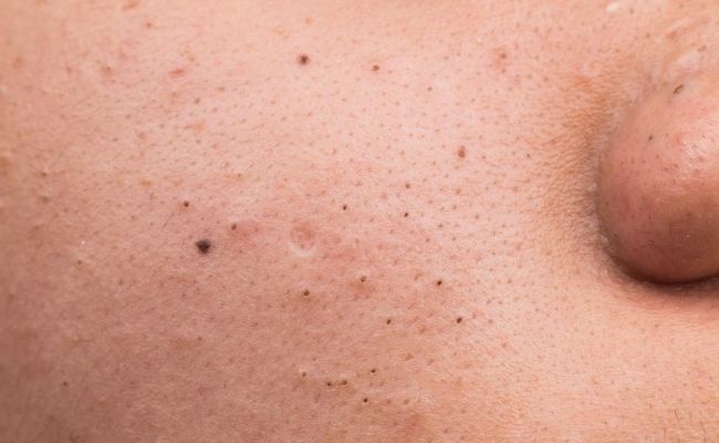 Các loại mụn thường gặp ở tuổi dậy thì