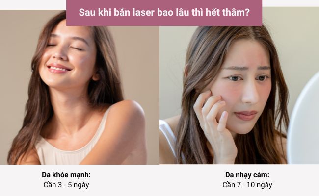 Sau khi bắn laser bao lâu thì hết thâm?