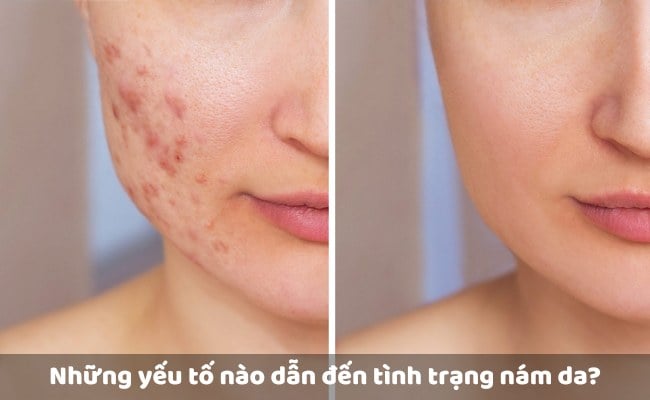 Hướng Dẫn Chăm Sóc Da Sau Nặn Mụn Không Thâm Sẹo | Kiehl's