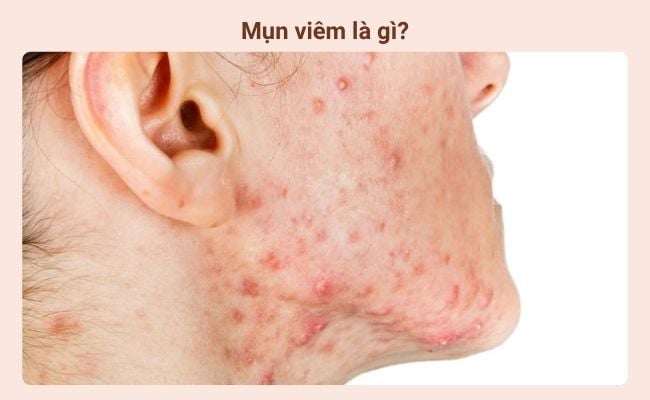 Mụn viêm là gì?